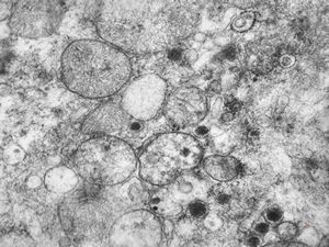 F,36y. | chemodectoma - neck